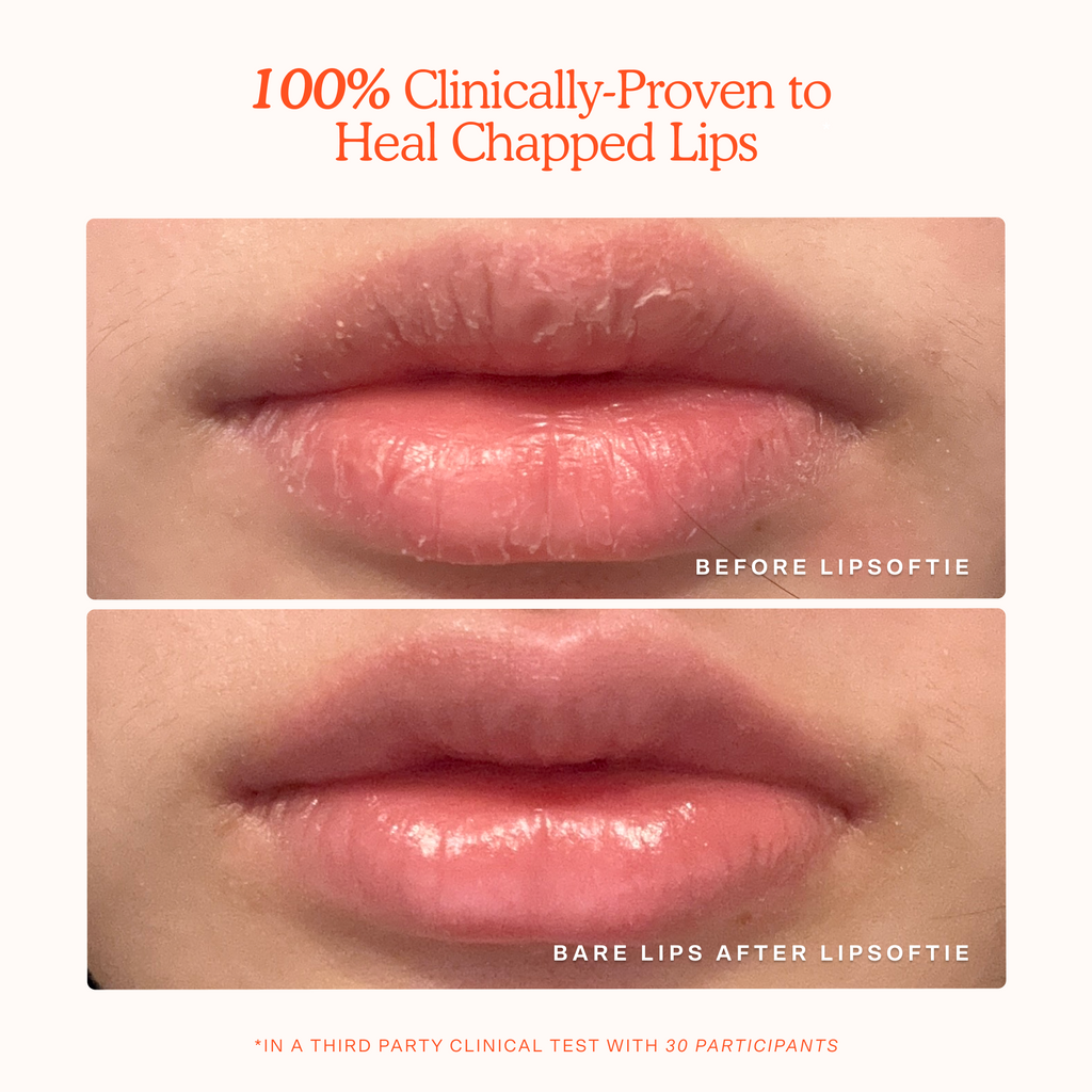 LipSoftie® Lip Treatment E1