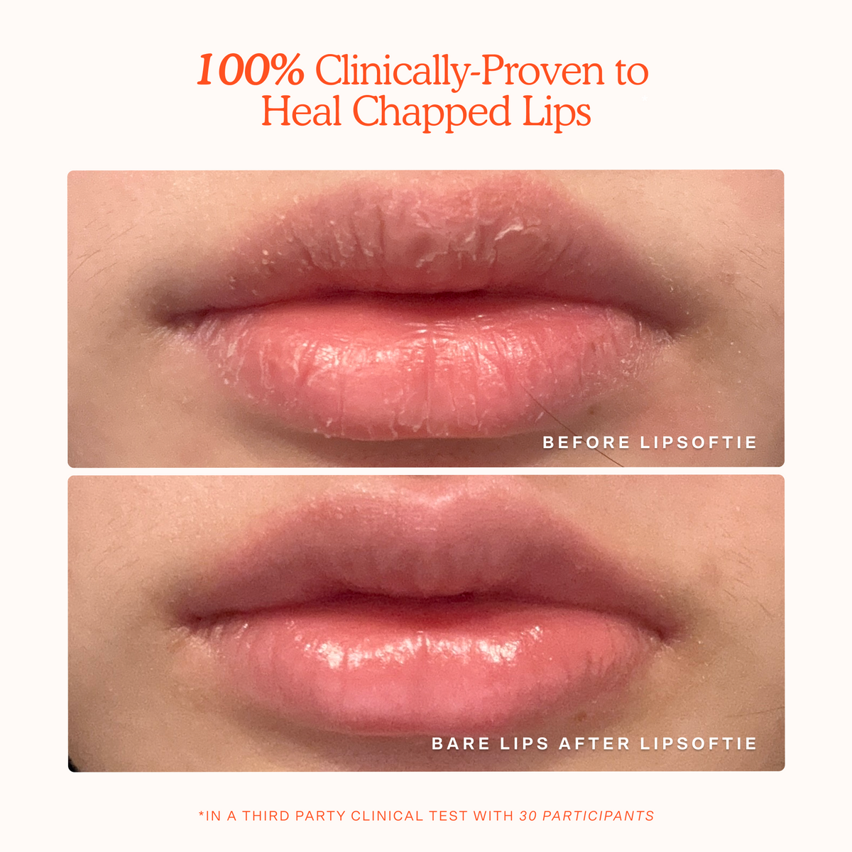 LipSoftie® Lip Treatment E1