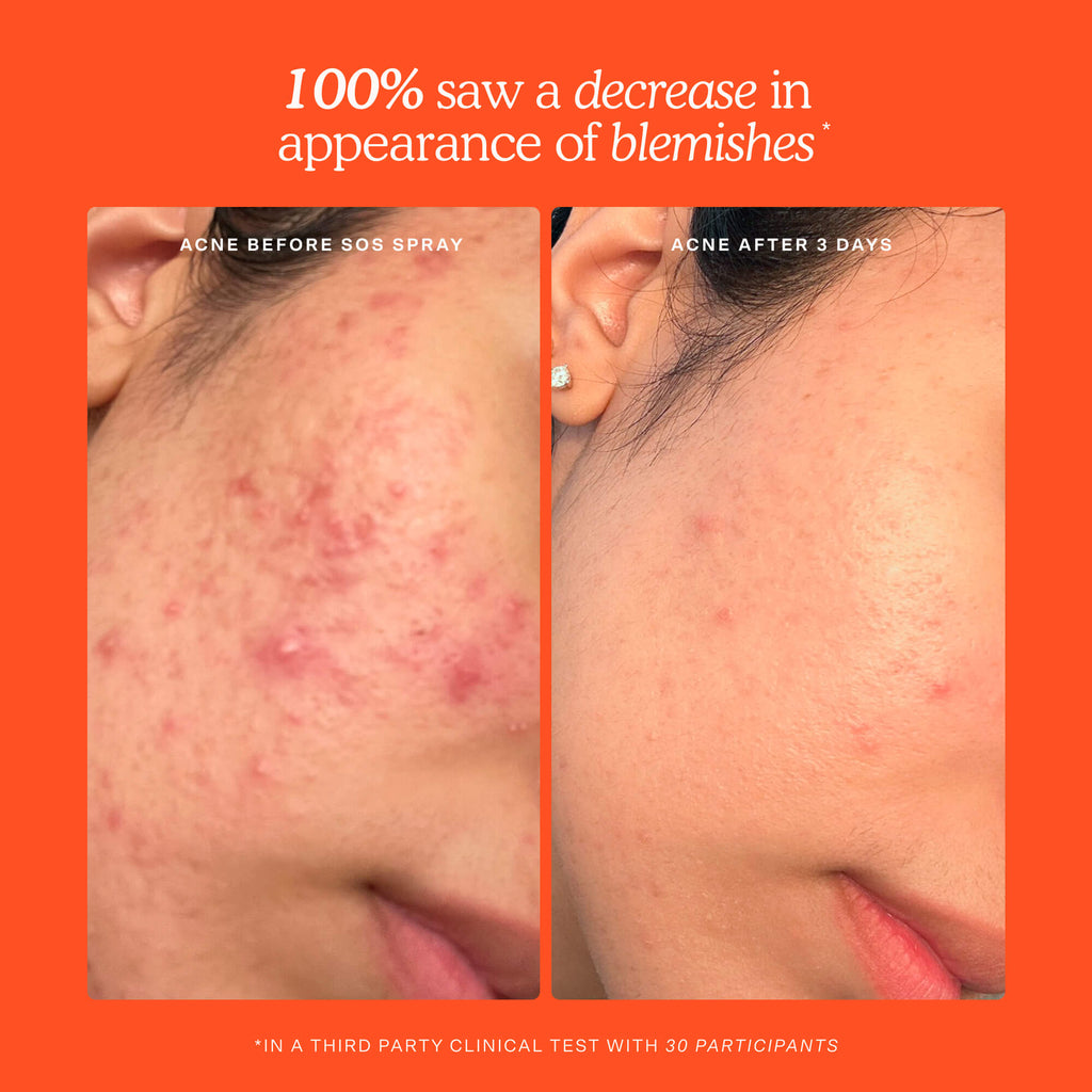 SOS 3-Step Skincare Set Q4