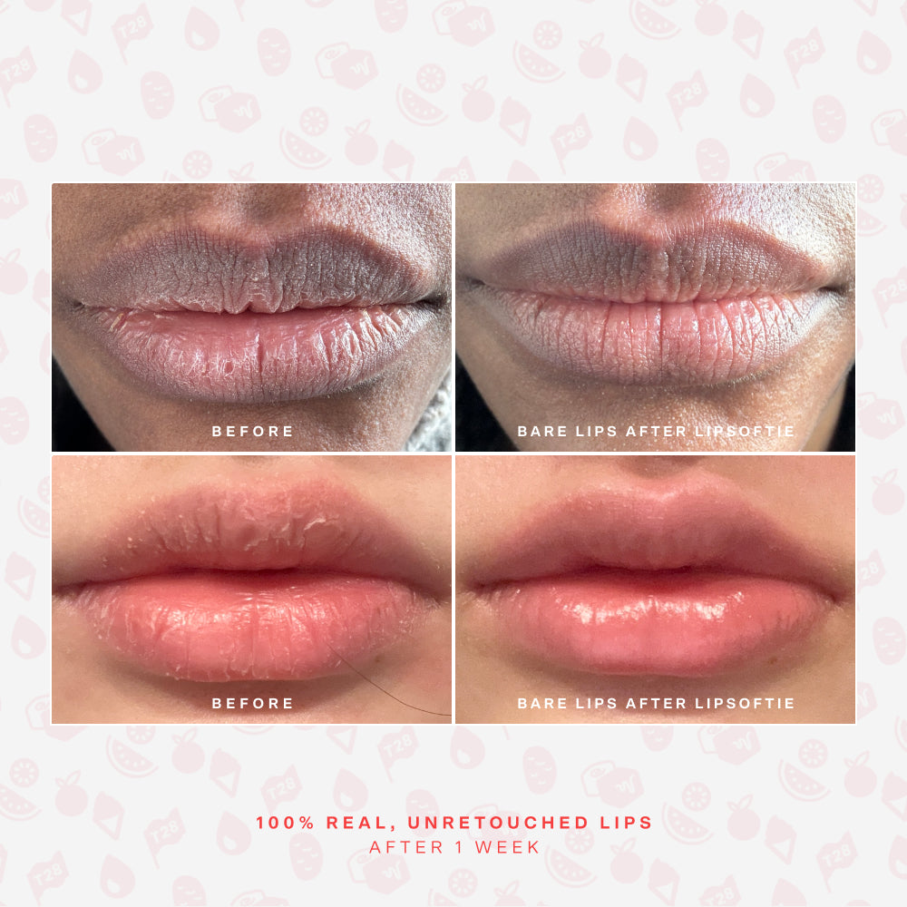 SOS LipSoftie® Lip Treatment B2