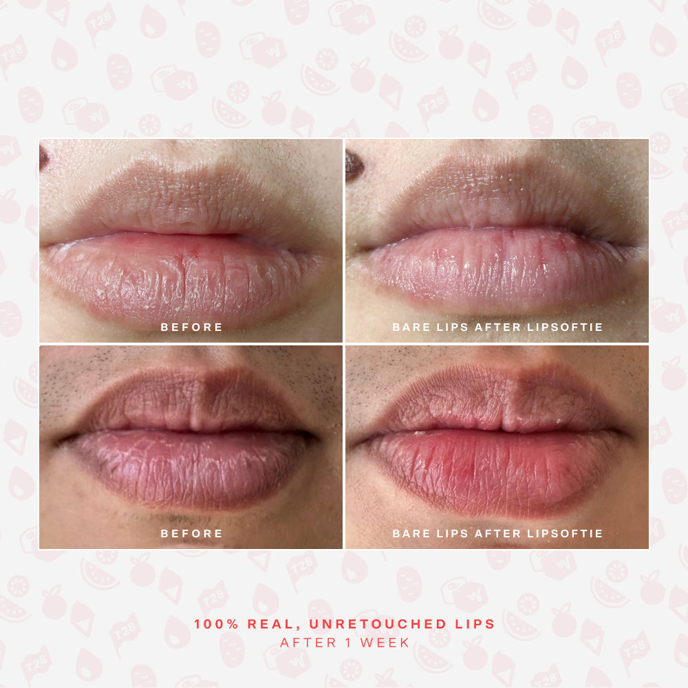 SOS LipSoftie® Lip Treatment B2