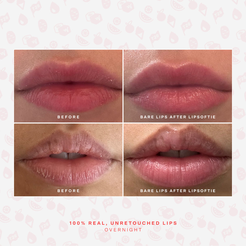 SOS LipSoftie® Lip Treatment B2